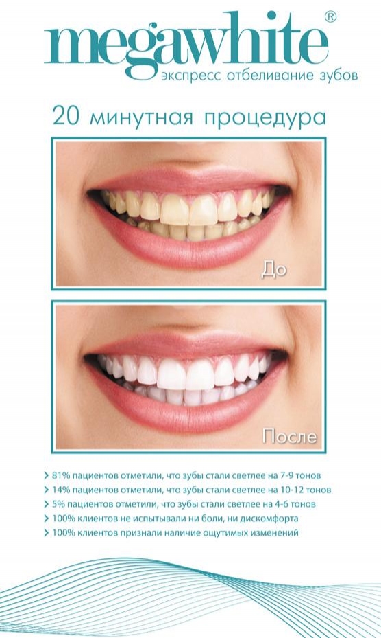 Отбеливание зубов плюсы и минусы процедуры гарантия на зубную щетку oral b